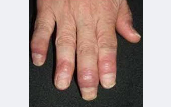 手指の末梢関節炎