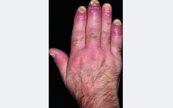 手指の指炎