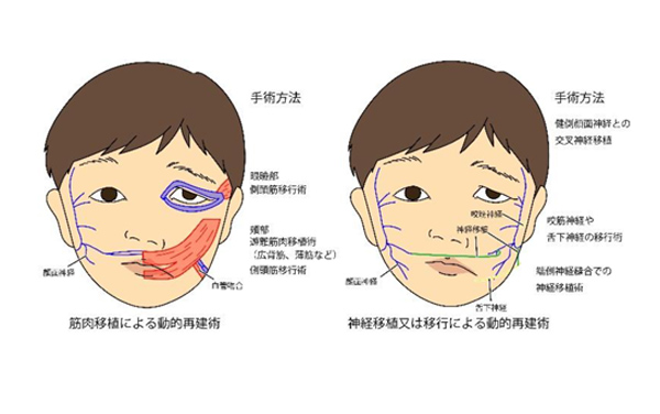 顔面神経麻痺の説明イラスト