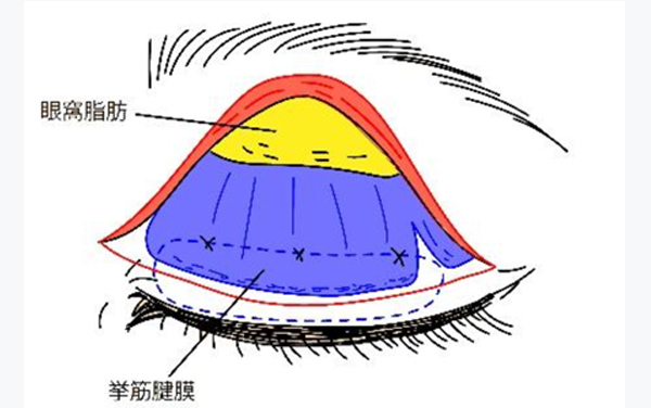 眼瞼下垂症の説明イラスト