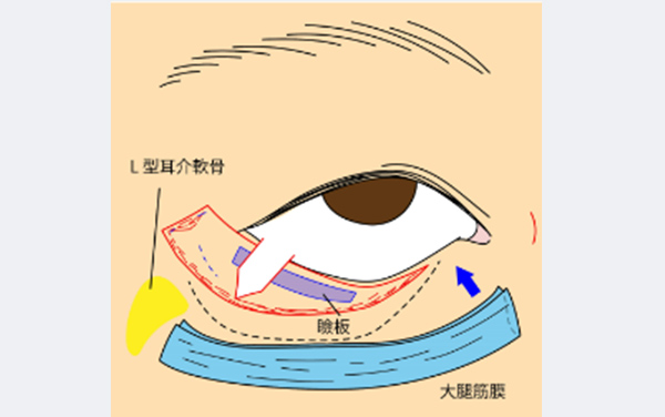 右麻痺性兎眼、眉毛下垂に対する静的再建例②