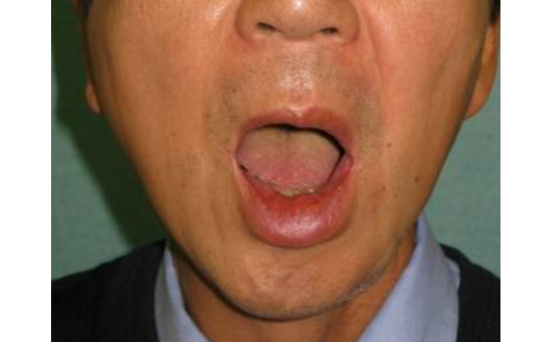 左口角下制筋麻痺による下口唇変形に対する静的再建例③