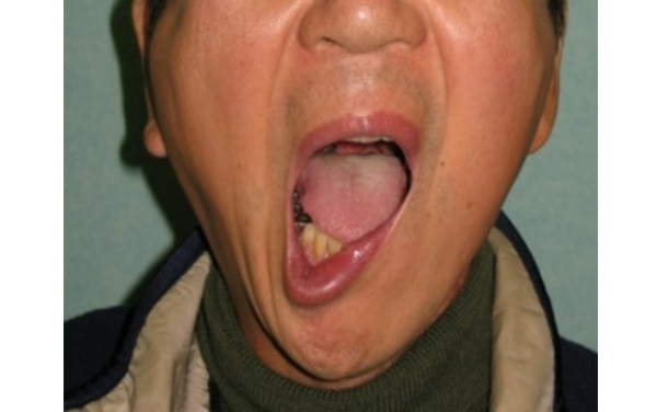 左口角下制筋麻痺による下口唇変形に対する静的再建例①