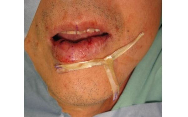 左口角下制筋麻痺による下口唇変形に対する静的再建例②