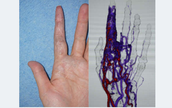 35歳女性　左手示指全周性病変の様子