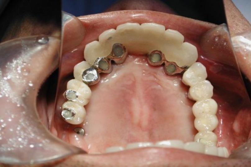 インプラント上に人工歯を装着する画像⑥