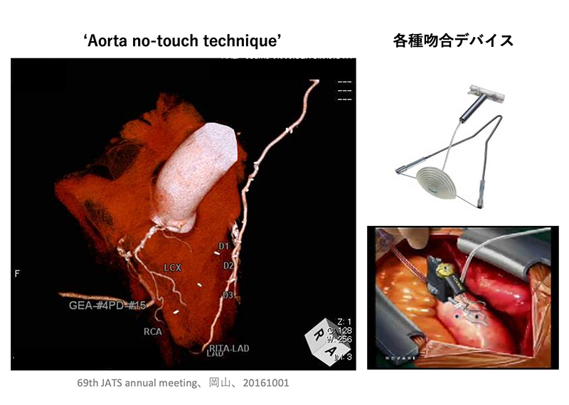 冠動脈バイパス手術のイメージ画像と器具の画像
