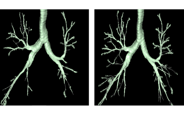 （図）重症喘息における治療前後の換気ができている気管支の評価（左：バイオ製剤使用前、右：バイオ製剤使用後）