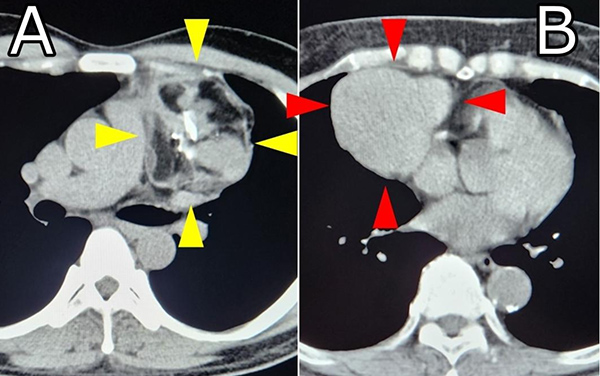 成熟奇形腫（図A）と胸腺腫（図B）の画像