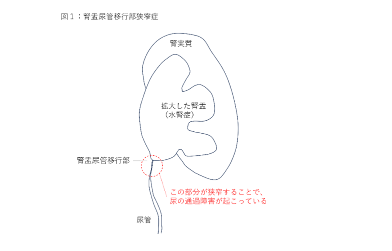 腎盂尿管移行部狭窄症の図