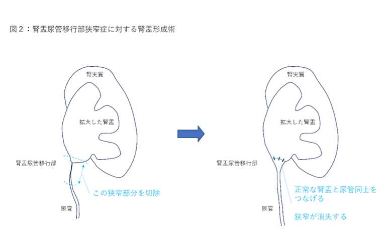ロボット支援腹腔鏡下腎盂形成術の図