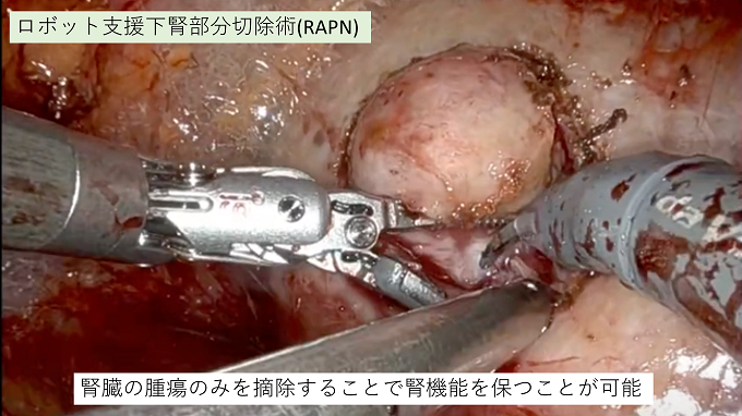 ロボット支援下腎部分切除術（RAPN）