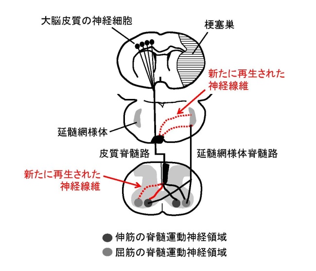 梗塞 延髄