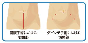 回復手術における切開部　ダビンチ手術における切開部