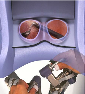 ３D視野のもと、手術操作が可能。