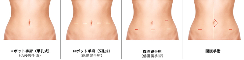 低侵襲手術の術式ごとの傷の違いの比較画像