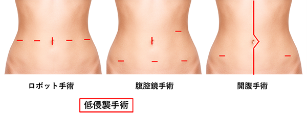 低侵襲手術の術式ごとの傷の違いの比較画像