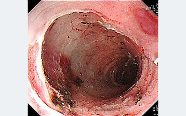 早期食道癌に対するESDの画像②
