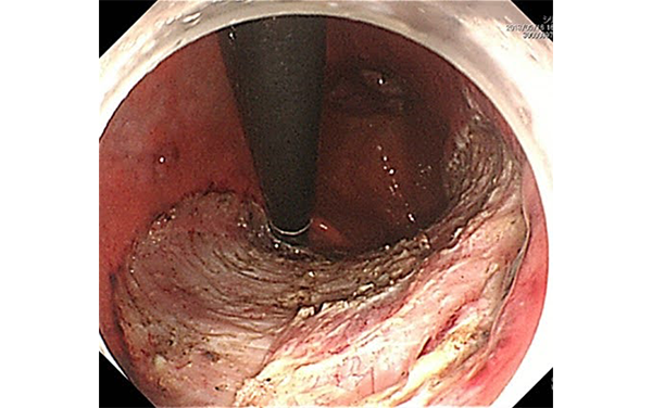 早期胃癌に対するESDの画像②