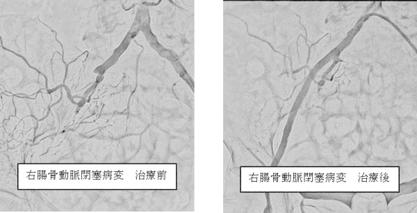 右腸骨動脈閉塞病変 治療前後の写真