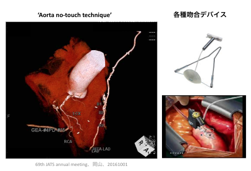 冠動脈バイパス手術のイメージ画像と器具の画像