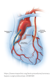 冠動脈のイラスト