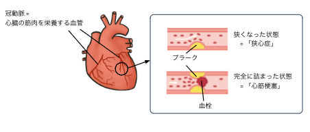 冠動脈が描かれた心臓のイラストと、狭心症と心筋梗塞になった冠動脈の拡大図