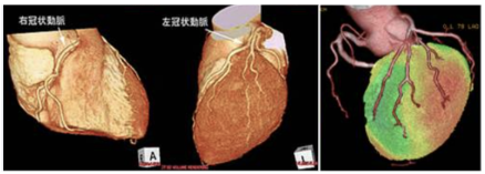 虚血性心疾患検査の写真