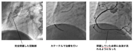 虚血性心疾患治療の写真