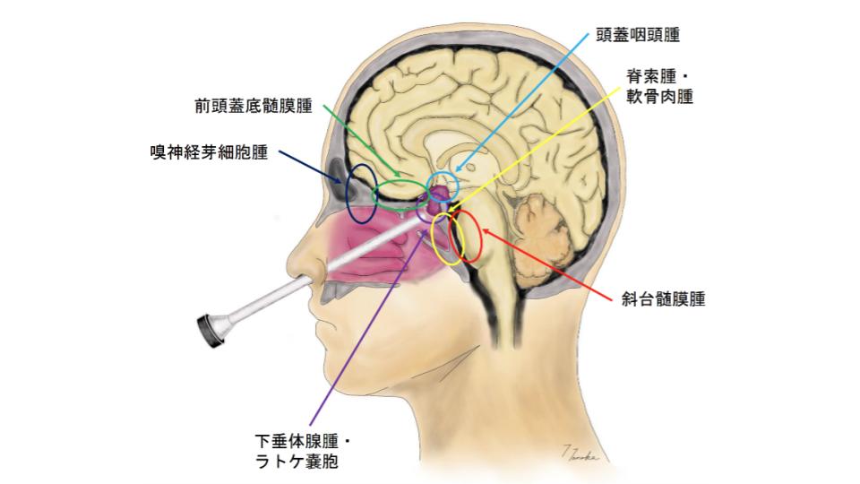 経鼻内視鏡下垂体・頭蓋底腫瘍摘出術の説明図①