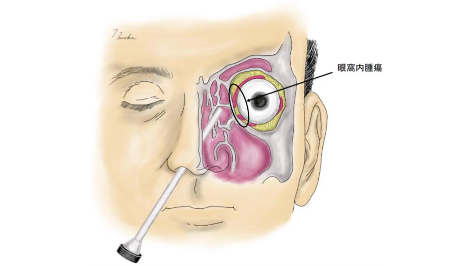 経鼻内視鏡下垂体・頭蓋底腫瘍摘出術の説明図②