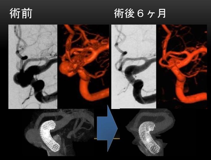 術前と術後6か月の比較画像