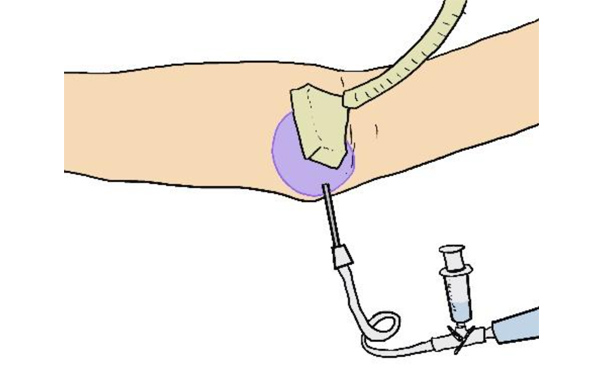 血管腫・血管奇形の説明イラスト