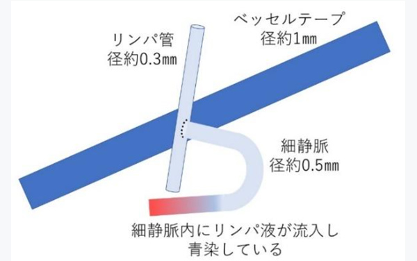 リンパ浮腫の説明イラスト