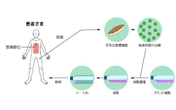 巨大色素性母斑の説明イラスト