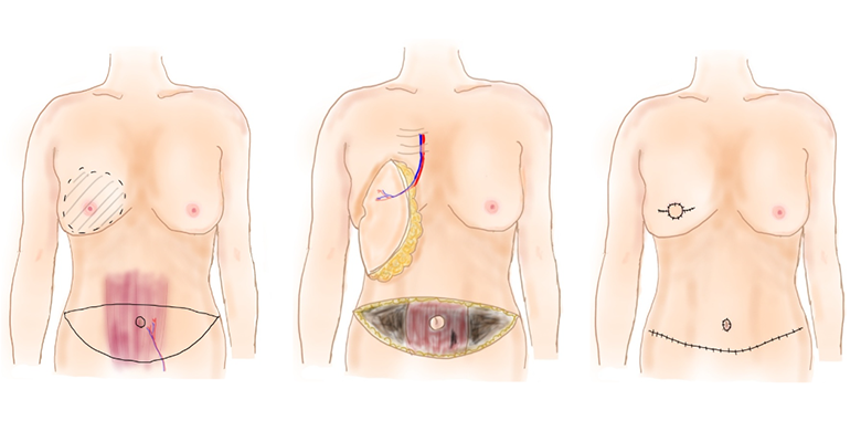 お腹の皮下脂肪を使用した方法のイラスト