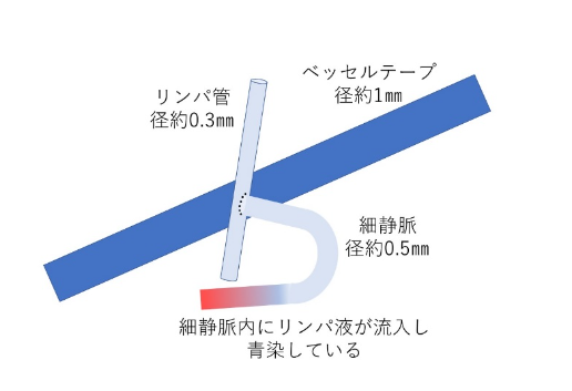 LVA吻合部の略式図