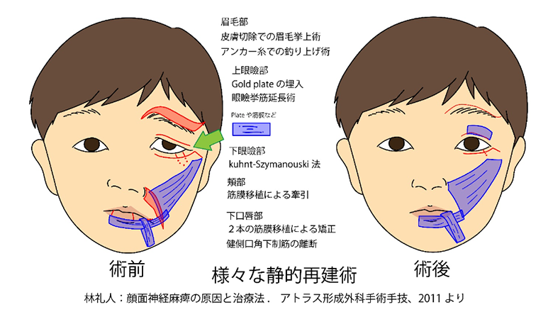 顔面神経麻痺静的再建術