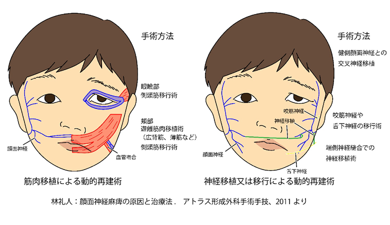 顔面神経麻痺動的再建術