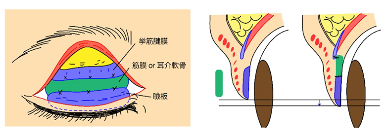 上眼瞼（うわまぶた）