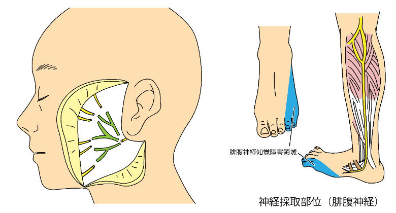 神経移植術