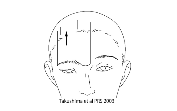 眉毛部画像②