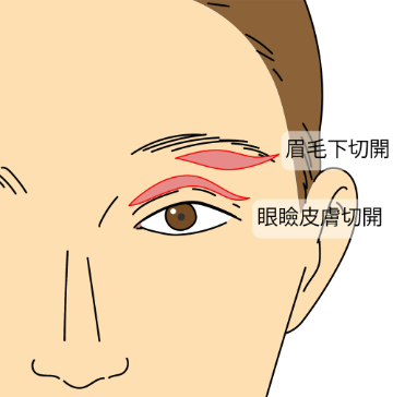 皮膚弛緩性眼瞼下垂