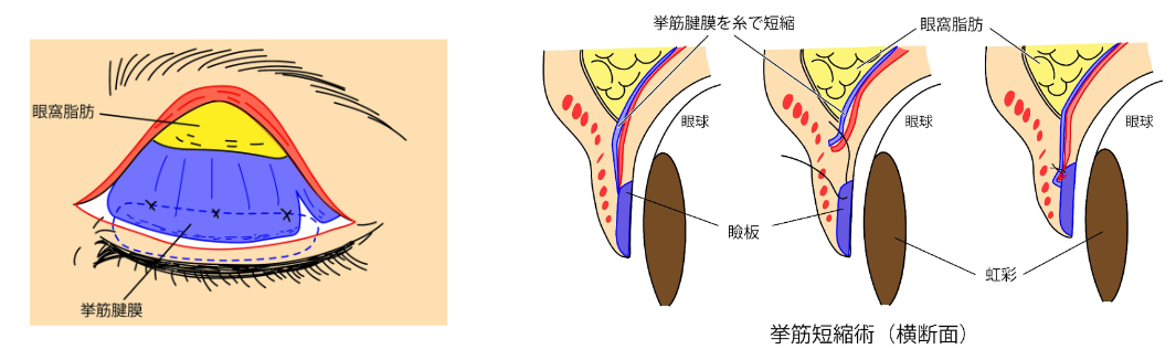 挙筋短縮術①