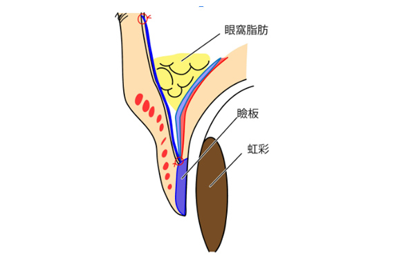 前頭筋つり上げ術（正面）②