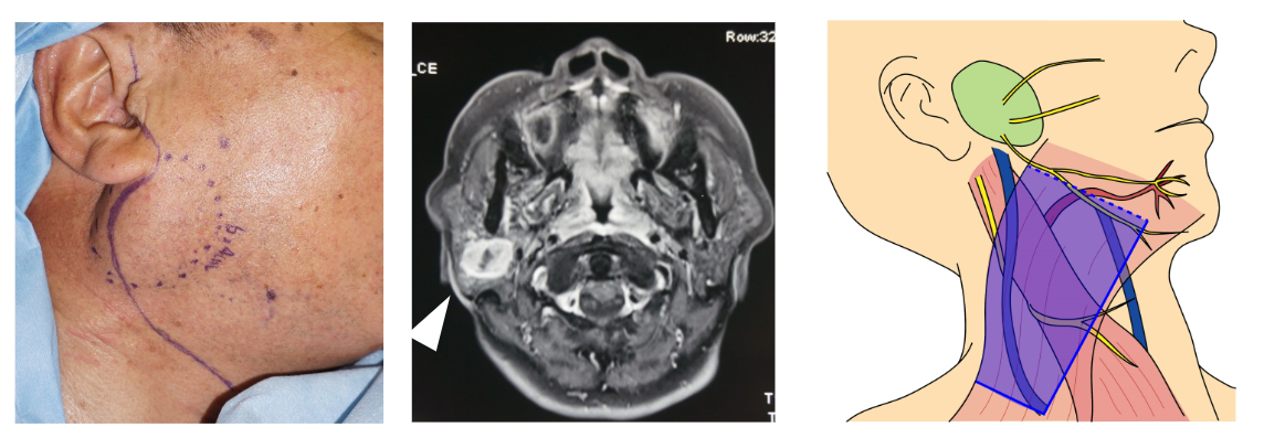 耳下腺腫瘍の画像