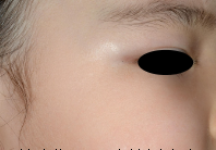 幼少期の眼瞼外側病変