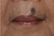 上口唇部の基底細胞癌の写真
