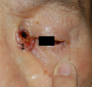 内眼角部基底細胞癌の写真