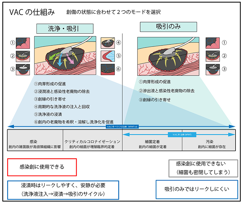 局所陰圧閉鎖療法